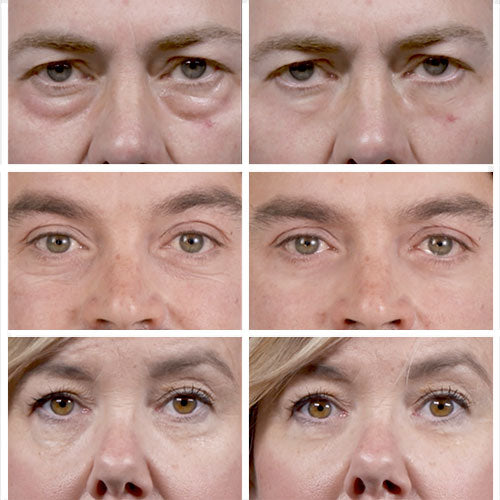 Thin Lizzy Puffy Eye Remover Best Eye Cream for Wrinkles in NZ