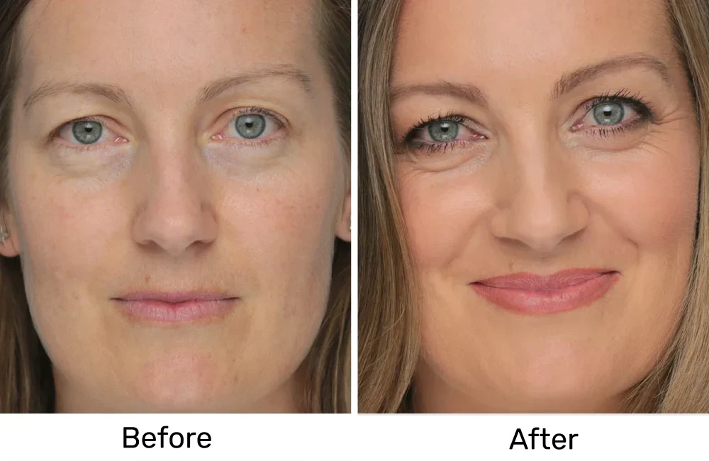 Still Hunting for the Best Concealer for Dark Under Eyes? Here's What Most of Them Get Wrong